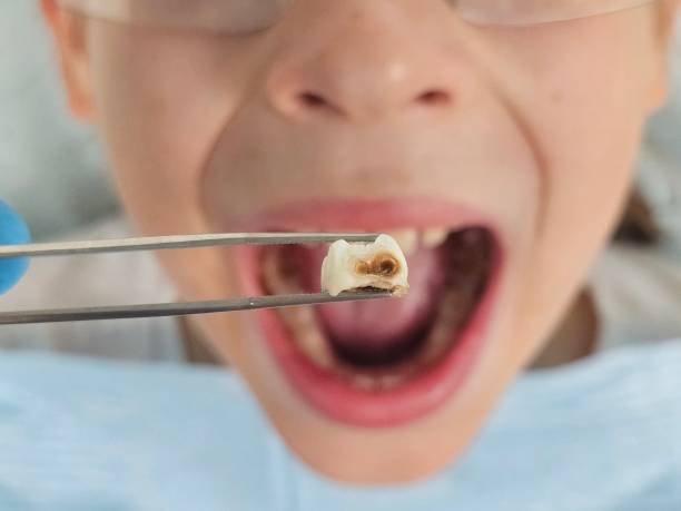 Best Emergency Dental Care for Broken or Chipped Teeth in East Williston, NY